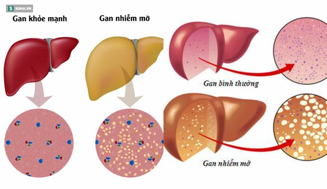 25% dân số thế giới mắc căn bệnh có thể tiến triển thành ung thư gan: Ai cũng nên biết - Ảnh 1.