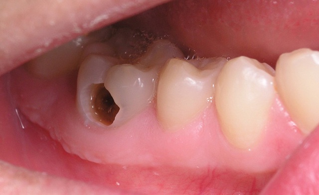 
Không chỉ gây tổn thương trực tiếp tới răng, các vi khuẩn sâu răng còn làm ảnh hưởng tới môi trường trong khoang miệng và khiến hơi thở nặng mùi. (Ảnh minh họa).
