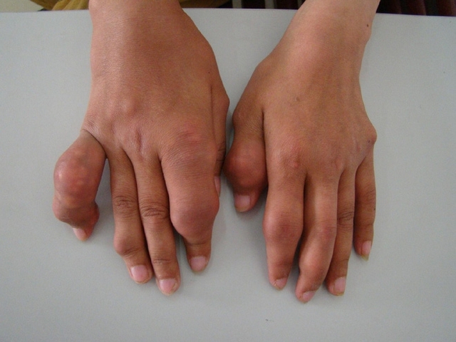 Bàn tay biến dạng của bệnh nhân gút (Ảnh minh họa)