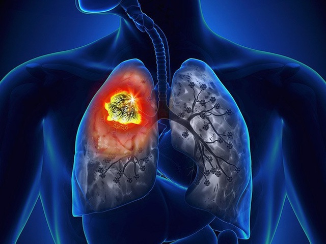 
Lá phổi đã bị suy yếu do các bệnh lý liên quan tới đường hô hấp càng có nguy cơ mắc ung thư cao. (Ảnh minh họa).
