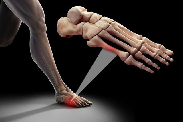 Gãy ngón chân sẽ tự khỏi mà không cần bó bột: Hóa ra đây là 5 điều mọi người hay hiểu lầm về xương - Ảnh 4. Gãy ngón chân sẽ tự khỏi mà không cần bó bột: Hóa ra đây là 5 điều mọi người hay hiểu lầm về xương - Ảnh 4.