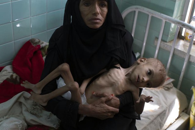 Bé gái trong bức ảnh gây chấn động thế giới về nạn đói đã qua đời, trở thành biểu tượng đau đớn của cuộc khủng hoảng tại Yemen - Ảnh 1.