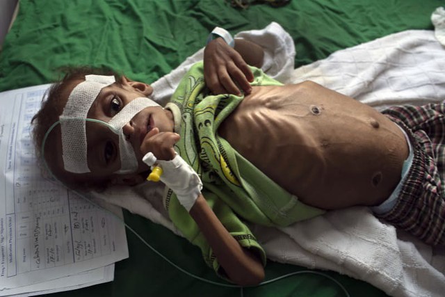 Bé gái trong bức ảnh gây chấn động thế giới về nạn đói đã qua đời, trở thành biểu tượng đau đớn của cuộc khủng hoảng tại Yemen - Ảnh 2.