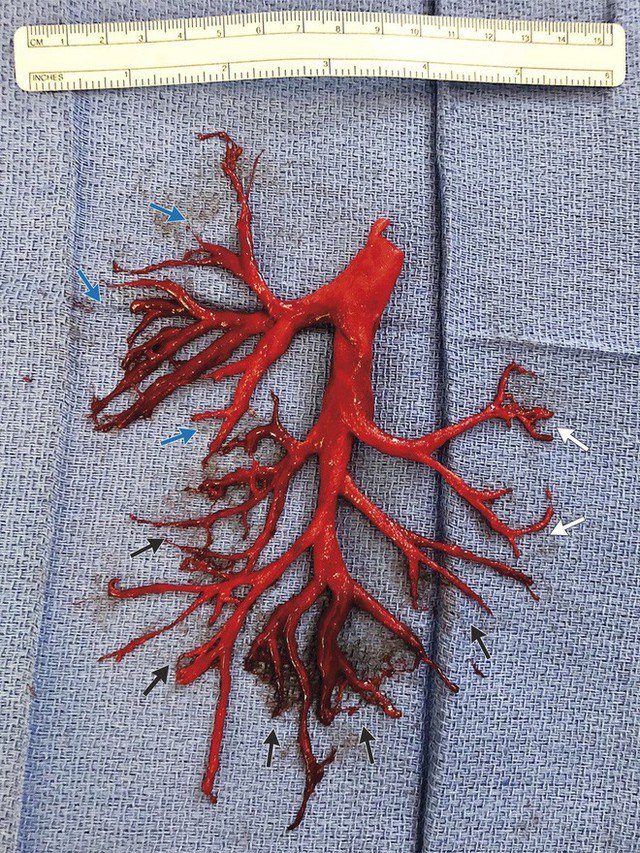 Đây là cục máu đông mà một bệnh nhân đã ho ra từ phổi, nó nằm ngoài sự tưởng tượng của tất cả các bác sĩ - Ảnh 1.