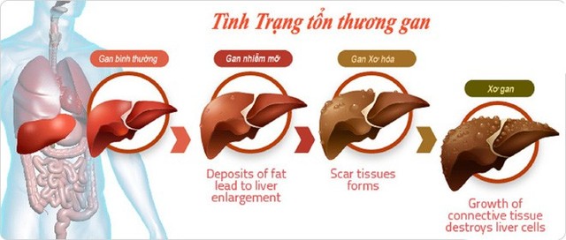  Xơ gan có thể dẫn đến ung thư gan: Đây là 4 nguyên tắc quan trọng giúp phòng ngừa hiệu quả - Ảnh 1.