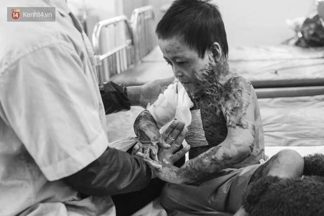 Xót xa những vết bỏng đau đớn trên người bé trai 6 tuổi: Ngày con phải cưa chân là ngày bạn bè vào lớp 1 - Ảnh 4. Xót xa những vết bỏng đau đớn trên người bé trai 6 tuổi: Ngày con phải cưa chân là ngày bạn bè vào lớp 1 - Ảnh 4.