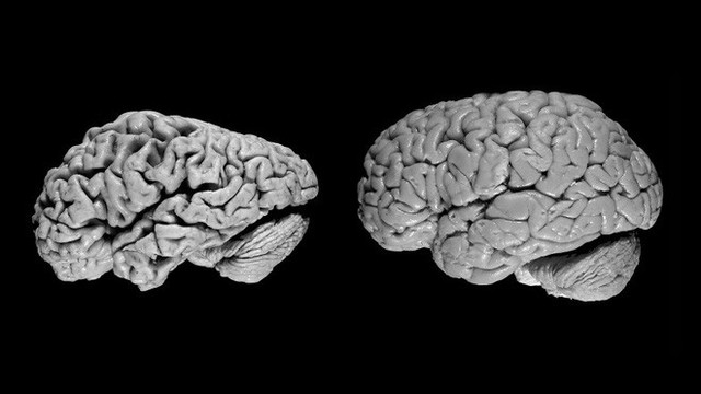 Trí tuệ nhân tạo phát hiện Alzheimer trong các bản chụp cắt lớp não sớm 6 năm so với chẩn đoán - Ảnh 1.