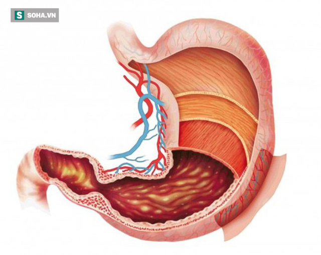 Những nhóm người dễ bị ung thư dạ dày: 3 việc cần làm ngay để ngăn ngừa mắc bệnh - Ảnh 1. Những nhóm người dễ bị ung thư dạ dày: 3 việc cần làm ngay để ngăn ngừa mắc bệnh - Ảnh 1.