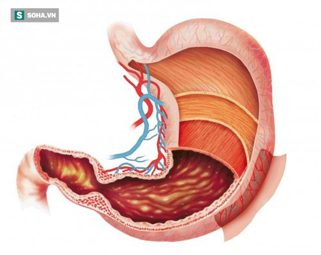  Những nhóm người dễ bị ung thư dạ dày: 3 việc cần làm ngay để ngăn ngừa mắc bệnh - Ảnh 1.