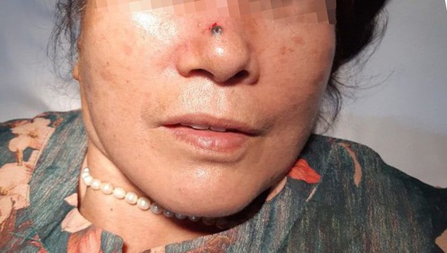 Nốt ruồi trên sống mũi bỗng hoá thành ung thư: Cách phân biệt nốt ruồi và ung thư - Ảnh 1. Nốt ruồi trên sống mũi bỗng hoá thành ung thư: Cách phân biệt nốt ruồi và ung thư - Ảnh 1.
