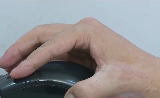 Việt Nam thực hiện thành công phẫu thuật siêu khó tầm cỡ quốc tế: lấy ngón CHÂN cái thay cho ngón TAY cái để phục hồi chức năng bàn tay! - Ảnh 6. Việt Nam thực hiện thành công phẫu thuật siêu khó tầm cỡ quốc tế: lấy ngón CHÂN cái thay cho ngón TAY cái để phục hồi chức năng bàn tay! - Ảnh 6.