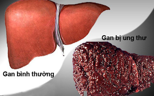 Ung thư gan đứng đầu trong các bệnh ung thư ở VN: GĐ BV Ung bướu chỉ 5 dấu hiệu cảnh báo - Ảnh 1.