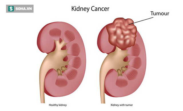  4 yếu tố chủ yếu có thể dẫn đến ung thư thận: Bất kỳ lứa tuổi nào cũng nên biết để tránh - Ảnh 1.