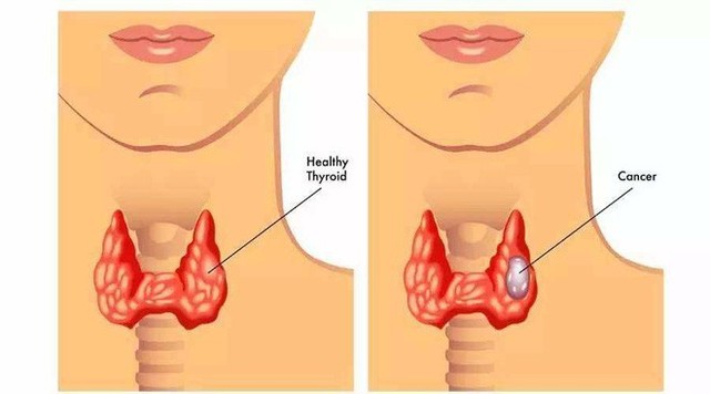  5 loại bệnh vặt không lo chữa, để quá lâu sẽ có nguy cơ tiến triển thành ung thư - Ảnh 4.