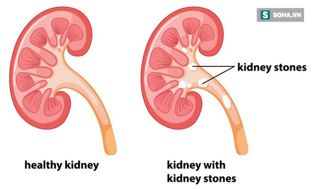  Muốn loại bỏ sỏi thận triệt để: Quan trọng nhất là giữ mồm giữ miệng trước những món này - Ảnh 1.