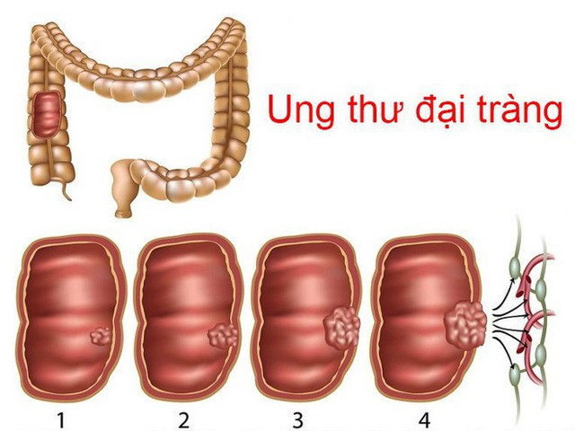 4 nhóm người có nguy cơ ung thư cao: BS khuyên khám ngay, chần chừ 1 năm cũng nguy hiểm - Ảnh 3.