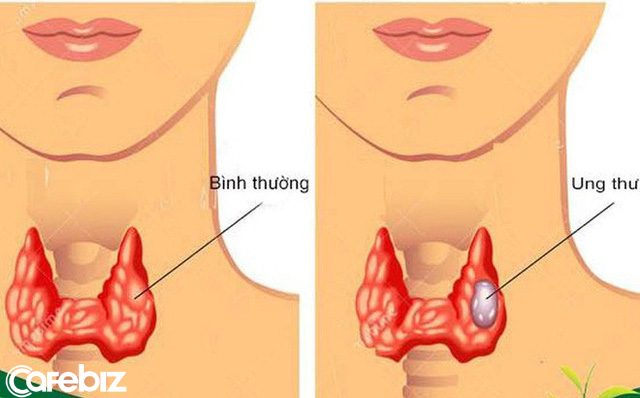 Cứ tưởng hắt hơi và ho chỉ là do dị ứng, tôi bàng hoàng khi biết mình bị ung thư tuyến giáp - Ảnh 3.