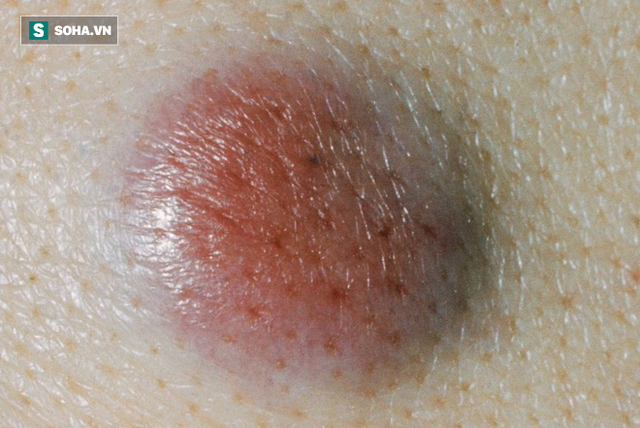  BS Mỹ chỉ cách phân biệt các loại ung thư da khác nhau, dấu hiệu phát hiện bệnh sớm nhất - Ảnh 5.