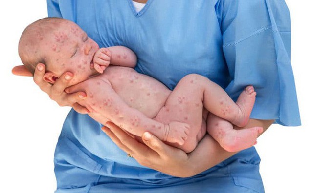 Nhờ vắc-xin, con người đã loại bỏ được 6 dịch bệnh nguy hiểm này - Ảnh 3. Nhờ vắc-xin, con người đã loại bỏ được 6 dịch bệnh nguy hiểm này - Ảnh 3.