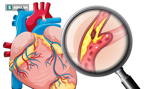 GS tim mạch tiết lộ: 2 thời điểm quỷ ám bùng phát cơn đau tim, ghi nhớ để tránh tử vong - Ảnh 2.