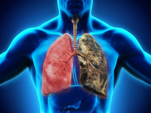 Chỉ là ho, nhưng triệu chứng ho thế này lại là biểu hiệu của ung thư phổi, bạn đã biết cách phân biệt chưa? - Ảnh 1.