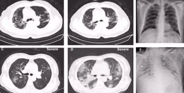 Phổi không còn là phổi! - Báo cáo khám nghiệm tử thi bệnh nhân nhiễm coronavirus hé lộ điều bất thường - Ảnh 4. Phổi không còn là phổi! - Báo cáo khám nghiệm tử thi bệnh nhân nhiễm coronavirus hé lộ điều bất thường - Ảnh 4.