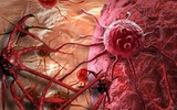 Tế bào ung thư mạnh hơn tế bào thường: 5 sai lầm có thể ảnh hưởng tính mạng người bệnh