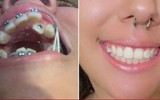 20 bức ảnh chứng minh niềng răng thay đổi nụ cười của bạn ra sao