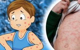Cảnh báo số ca mắc sởi tại Hà Nội tăng: Dấu hiệu trẻ mắc sởi chuyển nặng và việc cha mẹ cần làm để bảo vệ con