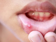 15 dấu hiệu ung thư phổ biến nhất: Nếu có bất cứ dấu hiệu nào nên đi khám ngay 15 dấu hiệu ung thư phổ biến nhất: Nếu có bất cứ dấu hiệu nào nên đi khám ngay
