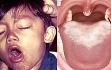 Bác sĩ Bệnh viện Bạch Mai chia sẻ thời gian ủ bệnh bạch hầu, tiết lộ những dấu hiệu rất dễ dàng bỏ qua