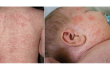 Hàng trăm ca bệnh sởi ở TP HCM, Sở Y tế kiến nghị ban hành kế hoạch ứng phó