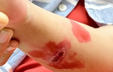 Bố mẹ tự chữa, nhiều trẻ nhập viện vì bệnh trở nặng