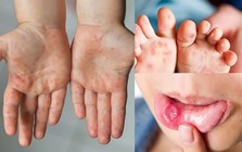 Nguy cơ dịch chồng dịch ở TP.HCM, ghi nhận hơn 3.000 ca một tuần