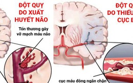 Giám đốc BV Đột quỵ: 80% trường hợp nhồi máu não có dấu hiệu này, biết sớm có thể cứu bạn khỏi đột quỵ