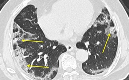 Không giống viêm phổi thông thường: Điều gì xảy ra với phổi của bệnh nhân nhiễm COVID-19?