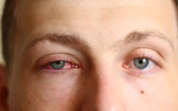 Viện Nhãn khoa Hoa Kỳ: Mắt đỏ nhẹ có thể là dấu hiệu của bệnh nhân nhiễm COVID-19