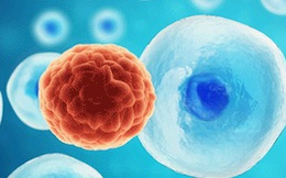 Kỹ thuật siêu âm mới có thể tiêu diệt tế bào ung thư dựa trên hiệu ứng sóng dừng