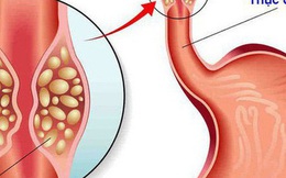 Phát hiện ung thư nhờ miếng thịt ngan: Bác sĩ nhắc khi ăn có dấu hiệu này phải khám ngay