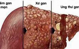 Người phụ nữ mắc ung thư gan điều trị 8 năm đã ổn định: "Bí quyết" thành công là gì?