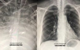 Ảnh chụp X-quang phổi cho thấy tác dụng tuyệt vời của vaccine Covid-19
