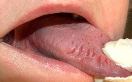 2 tổn thương trên lưỡi ngầm cảnh báo thực quản có vấn đề, đừng chủ quan bỏ qua