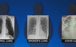 BS so sánh 3 lá phổi: Bệnh nhân Covid-19 có hậu quả tổn thương nghiêm trọng hơn, bị sẹo phổi