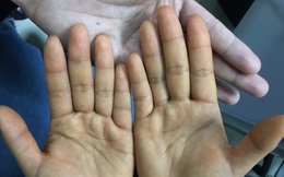 Ăn quá nhiều đu đủ, da vàng như nghệ, cô gái Hà Nội vội vàng tới bệnh viện khám
