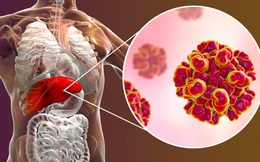 Đây là 4 lý do khiến bạn dễ bị ung thư gan: Cách phòng ngừa hiệu quả thật sự không khó