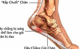 Bi đau gót chân là biểu hiện của bệnh gì? Có nguy hiểm không?