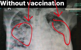 4 bức ảnh chụp phổi của bệnh nhân Covid-19 đã tiêm các loại vắc xin khác nhau và không tiêm: Kết quả gây sốc!