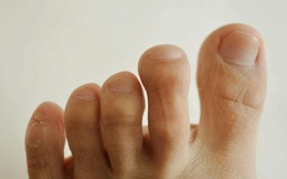 3 đặc điểm bất thường ở bàn chân có thể là dấu hiệu cảnh báo ung thư, xem thử bạn có sở hữu điểm nào không