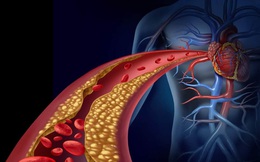 Cholesterol máu có thể gây tử vong ‘bất đắc kỳ tử’: Ăn ngay những thực phẩm này để đẩy lùi cholesterol xấu!