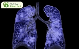 Omicron có thể gây sưng phổi - 14 dấu hiệu bạn không bao giờ được bỏ qua